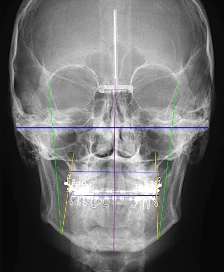Telerradiografía Frontal