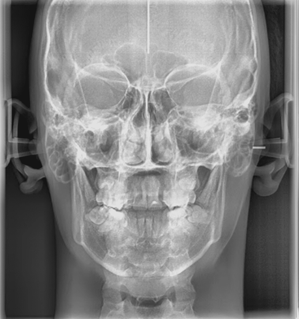 Telerradiografía Frontal en uso