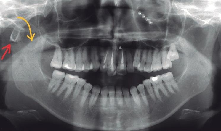 Detalle de A.T.M. Posteroanterior