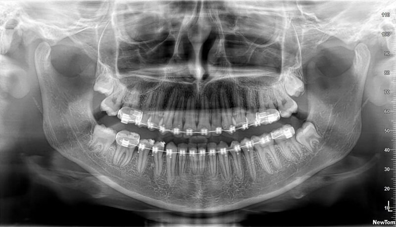 TAC maxilar o mandibular
