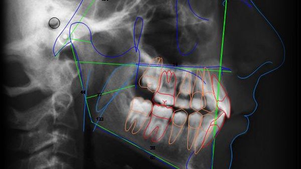 Telerradiografía Lateral en detalle